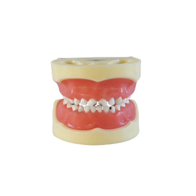 

Dental teaching Model Caries model of child (Gum can be removed)