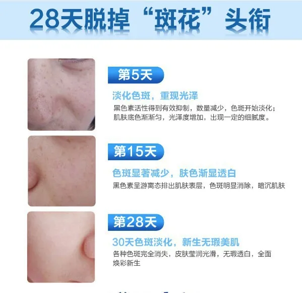 2N 28 days Medicated Pigment Skin Whitening Cream Chloasma Cyasma Melanin Removing freckle speckle Firm skin care face care