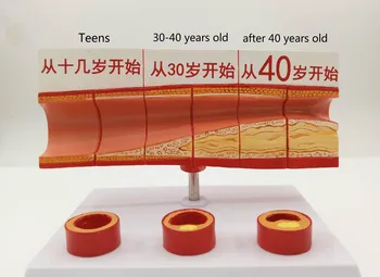 

Different Age Blood Vessel Anatomical Model Vascular Atherosclerosis Anatomy Model Vascular Obstruction Model Medical Models