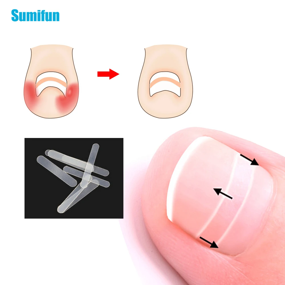 10 шт., коррекция вросших ногтей, наклейки, пластырь для ухода за ногами, пилочка для коррекции пароникции, эластичная заплатка, корректор, лечение C1510