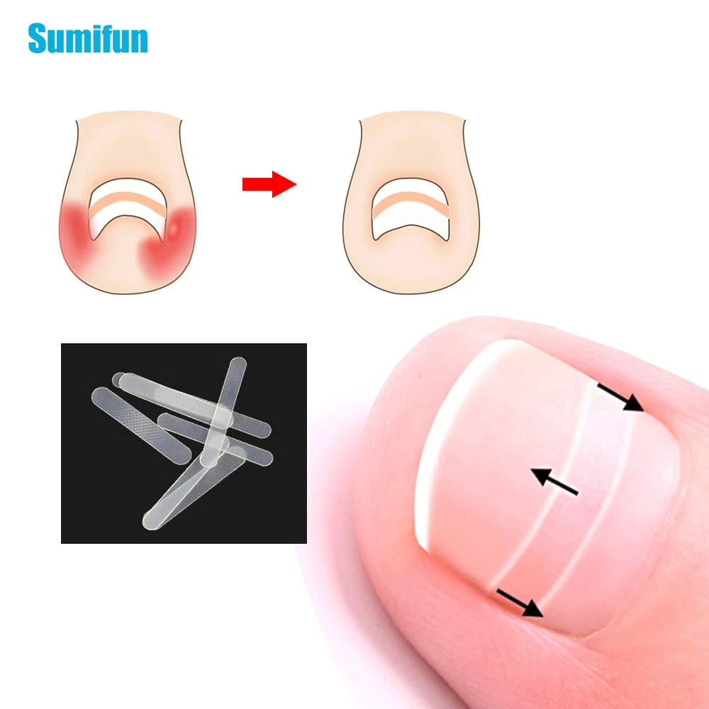 10pcs Toe Nail Ingrown Correction Sticker Patch Foot Care Paronychia Correction File Elastic Patch Corrector Treatment C1510