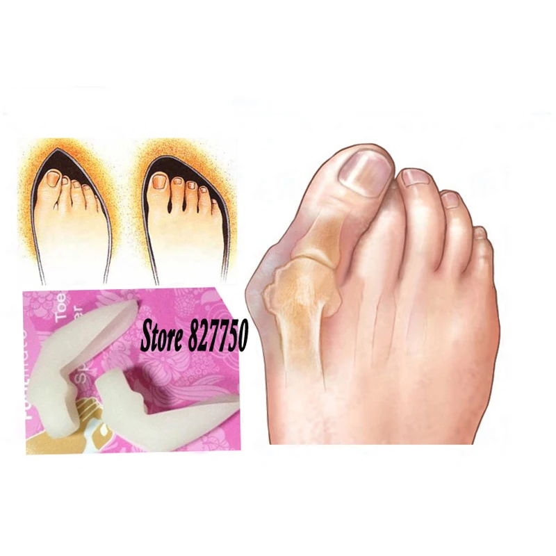 Genuine Special Hallux Valgus Pro Bicyclic Bone Orthotics Braces Toe Separator Pedicure Corrector Protector Bunion Adjuster
