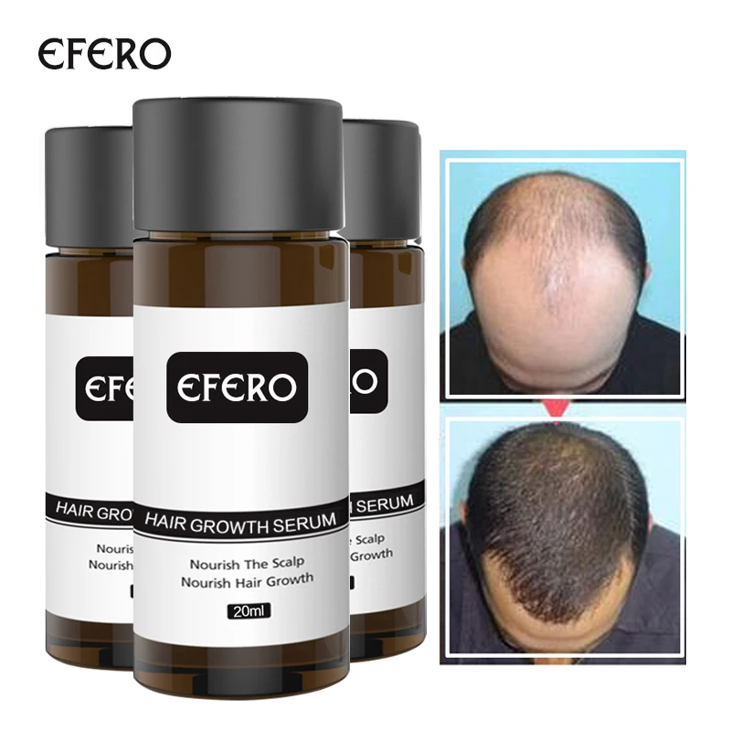 EFERO 1 шт. мощная Сыворотка от выпадения волос Эссенция от выпадения волос эфирное масло более толстый рост волос предотвращает облысение продуктов