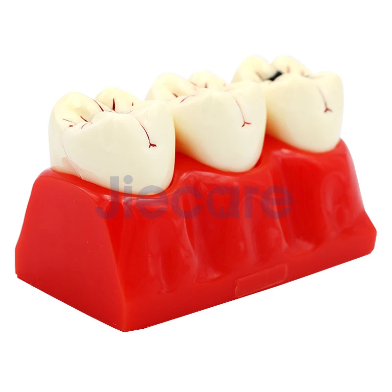 1 шт. зубной протез зубов Модель кариеса disasscmbking сравнительная модель кариеса модель Стоматолог патологий для медицинской учебной