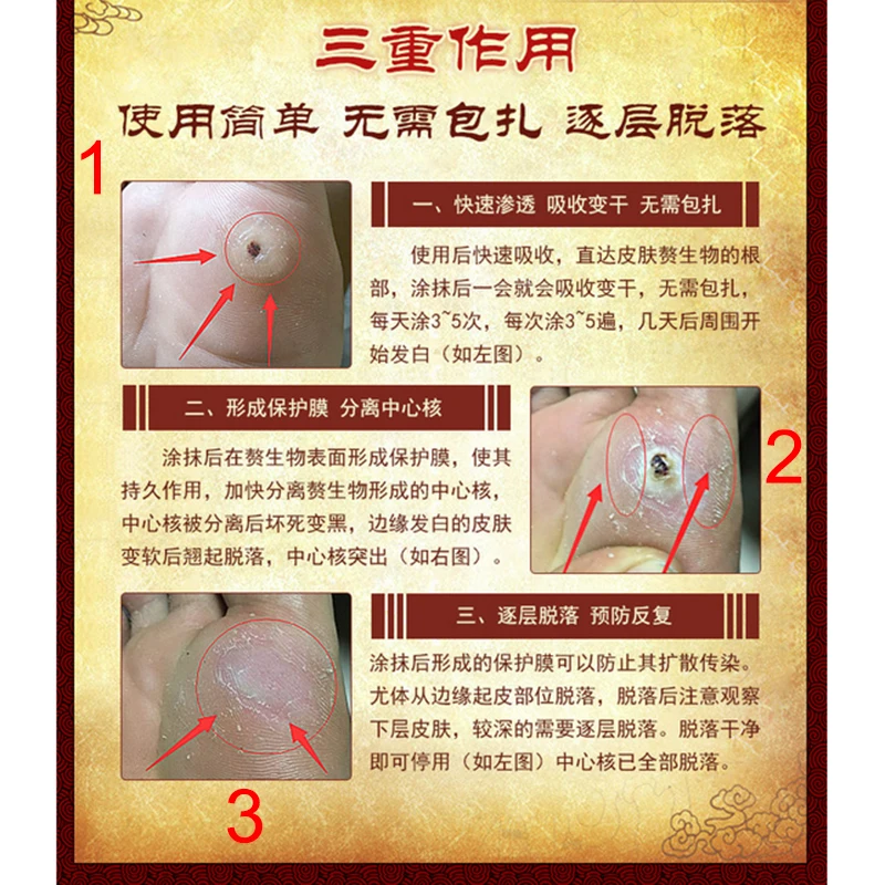 Лечение китайской медициной для удаления кукурузы на ногах подошвенные бородавки Pomada De Verruga Уход за ногами медицинская штукатурка удаление бородавок