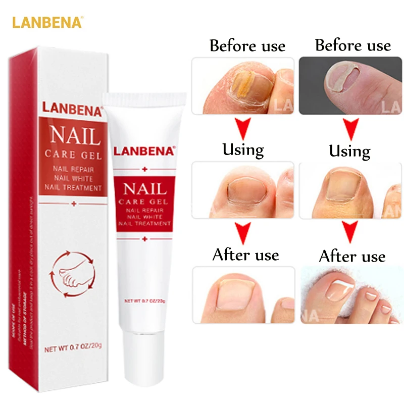 

LANBENA Nail Treatment Cream Bright Fungal Nail Repair Onychomycosis Removal Essence Foot Care Brightening Hand And Foot Care