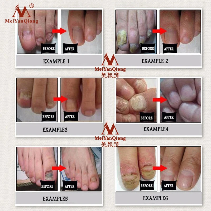 Fungal Nail Treatment Feet Care Essence Nail Foot Whitening Toe Nail Fungus Removal Gel Anti Infection Paronychia Onychomycosis