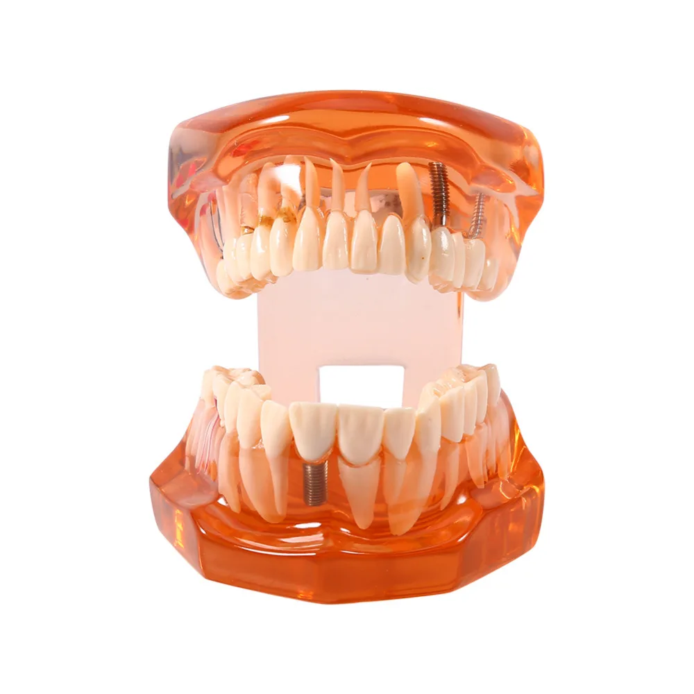 

Dental Disease Removable Study Teaching Teeth Model Orange Color