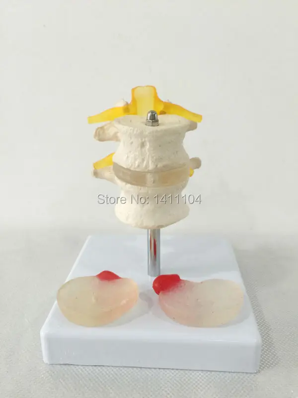 Free shipping office&2 lumbar vertebrae with 2 lesions of intervertebral disc, human skeletal model, human model