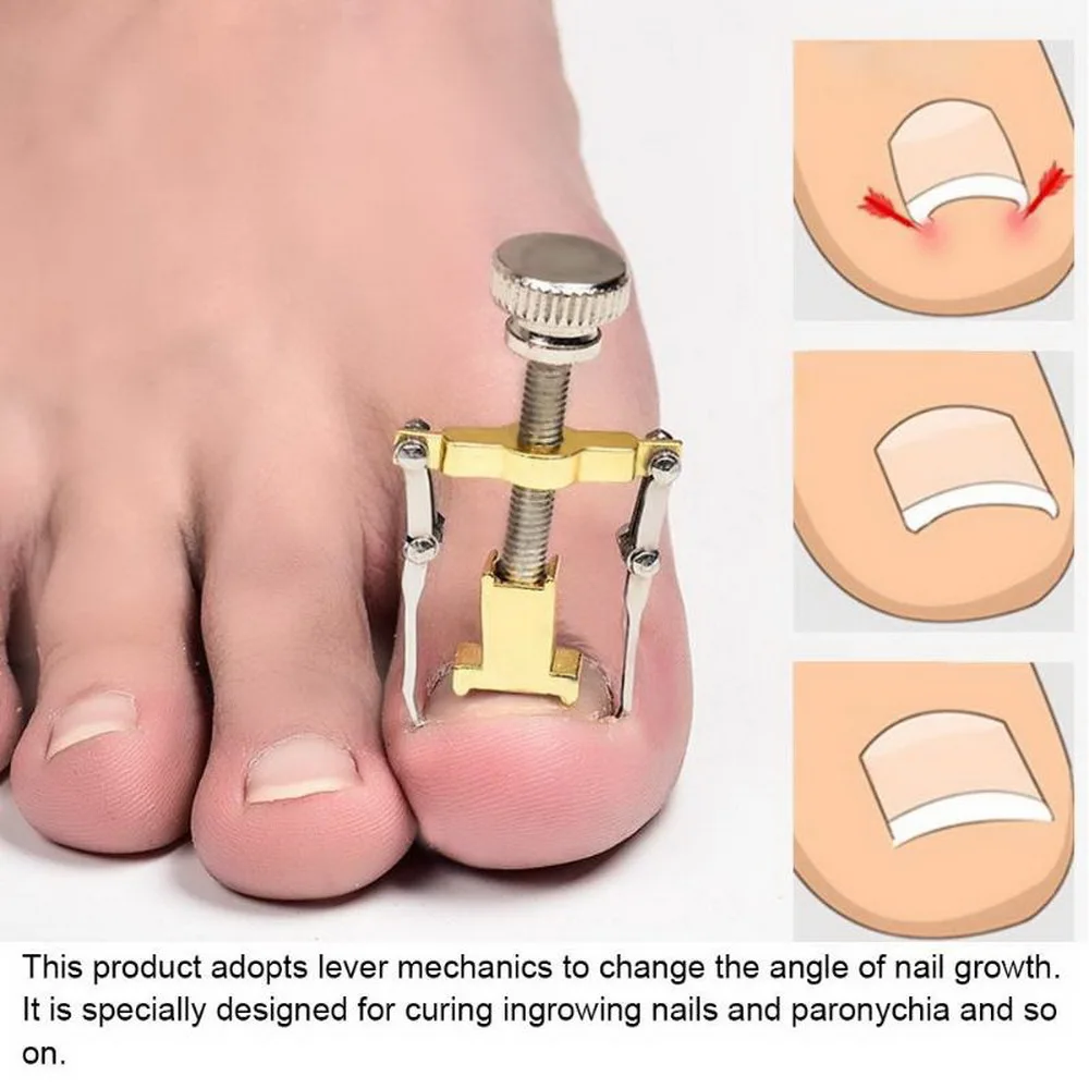 

Ingrown Toe Nail Fixer Pedicure Toenail Recover Nail Correction Tool orthotic nail bunion corrector foot nail care tool