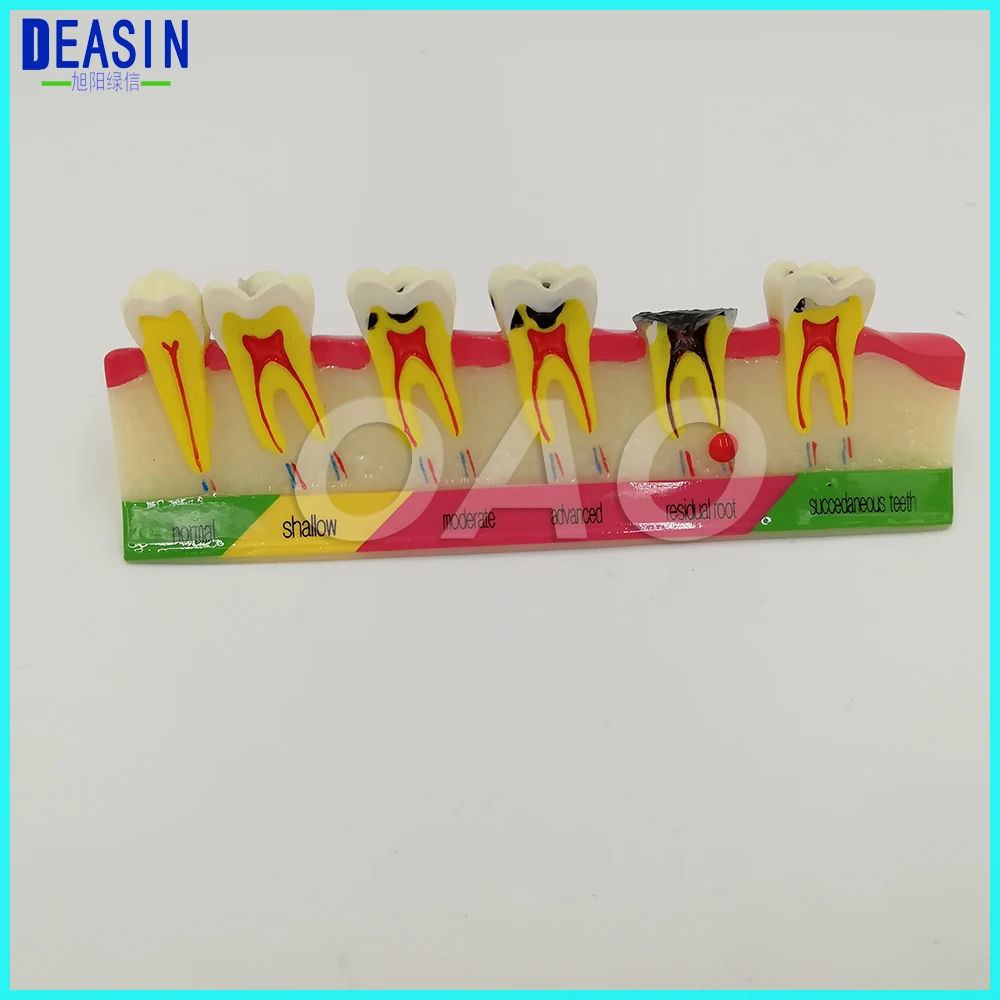 free-shipping-dental-caries-developing-illusteation-tooth-model-demonstration-teach-patient