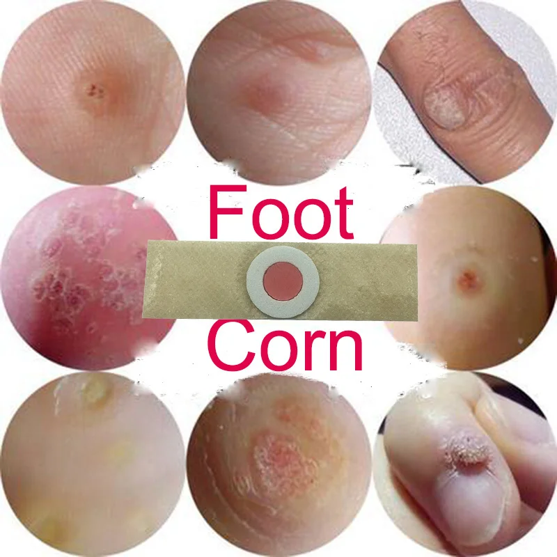10pcs Foot Care Medical Plaster Foot Corn Removal Calluses Plaster Warts Thorn Plaster Health Care For Relieving Pain 10pcs Foot Care Medical Plaster Foot Corn Removal Calluses Plaster Warts Thorn Plaster Health Care For Relieving Pain