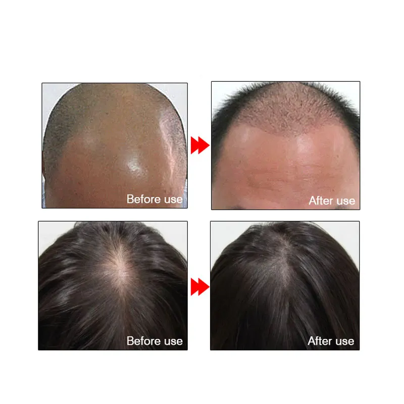 ARTISCARE эфирное масло для роста волос против выпадения волос Жидкое средство для восстановления волос для мужчин t плотная Сыворотка для волос для женщин и мужчин
