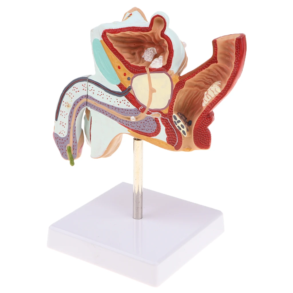 1:1 Human Male Reproduction Urinary System Pathlology Model Gonorrhea Ureteral Calculus Display Medical Study Lab Supplies