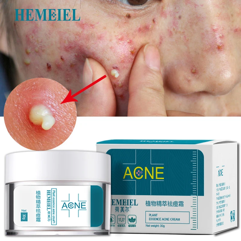 HEMEIEL Acne Treatment Face Cream Anti Acne Scar Removal Pimple