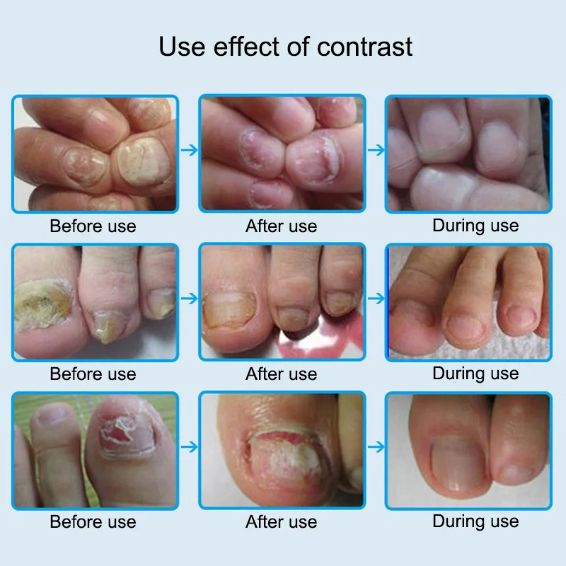 Ногти удаляют эфирное масло поврежденные ногти ног смягчение для лечения рингчервя грибок онихомикоз SSwell
