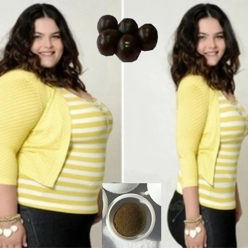 Adipocytes after weight loss Adipocytes after weight loss other words, lot