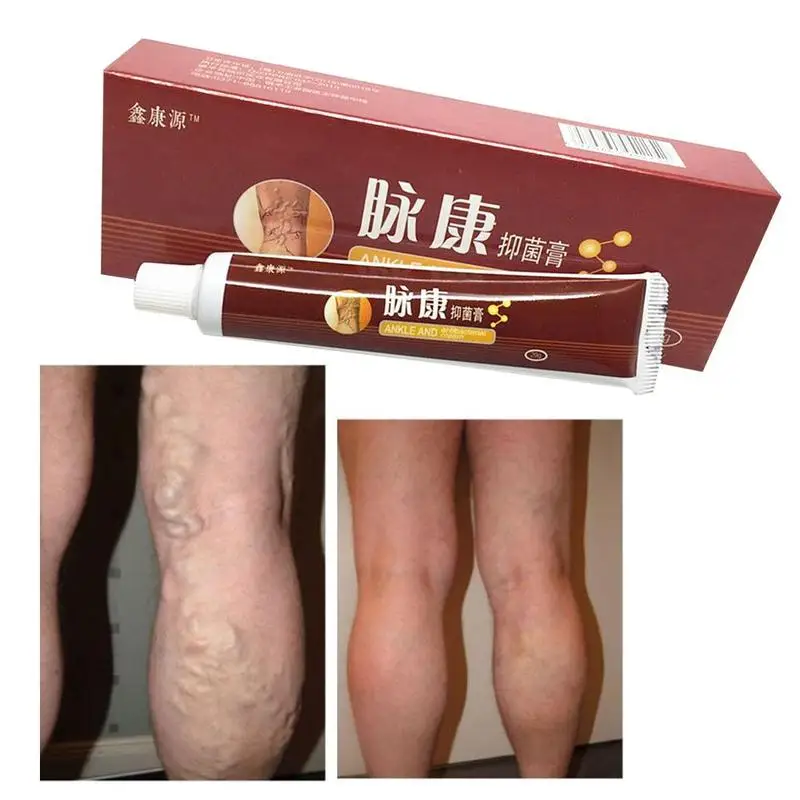 20g Varicose Veins Treatment Cream Ointment Vasculitis Phlebitis Spider Pain Varicosity Angiitis Remedy Removal Herbal Cream