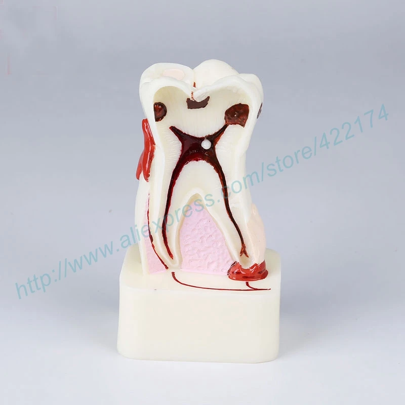 Free Shipping 4size pathological dental model tooth teeth dentist dentistry anatomical anatomy model odontologia Free Shipping 4size pathological dental model tooth teeth dentist dentistry anatomical anatomy model odontologia