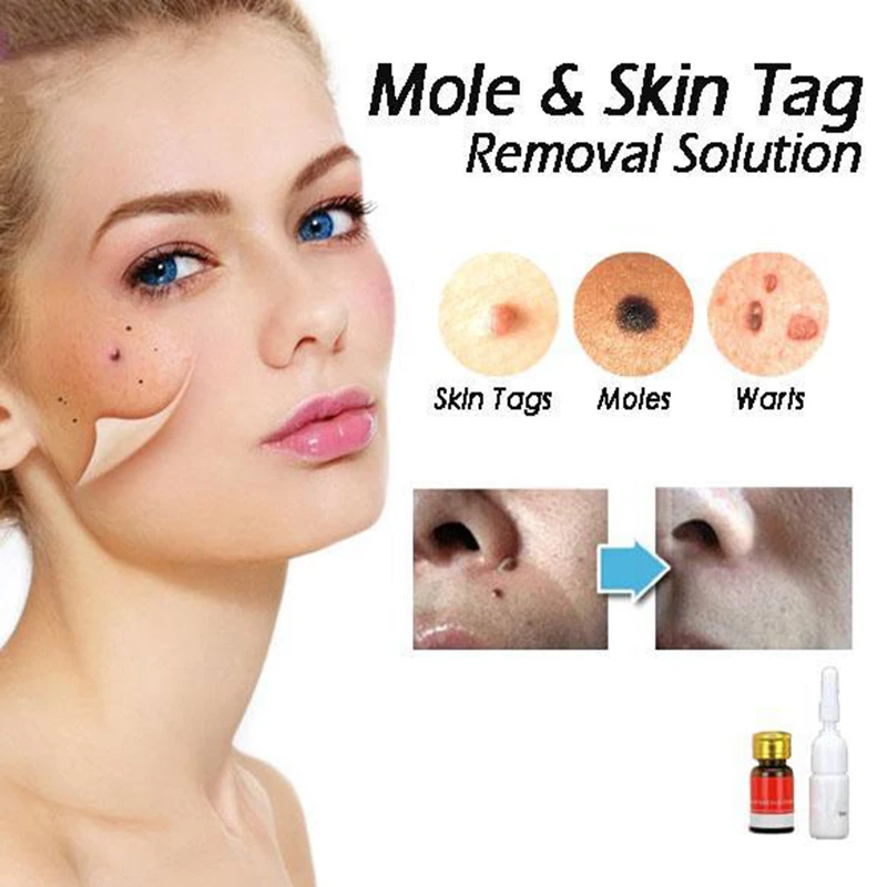 

Mole & Skin Tag Removal Solution Painless easy to apply drop shipping skin care tools