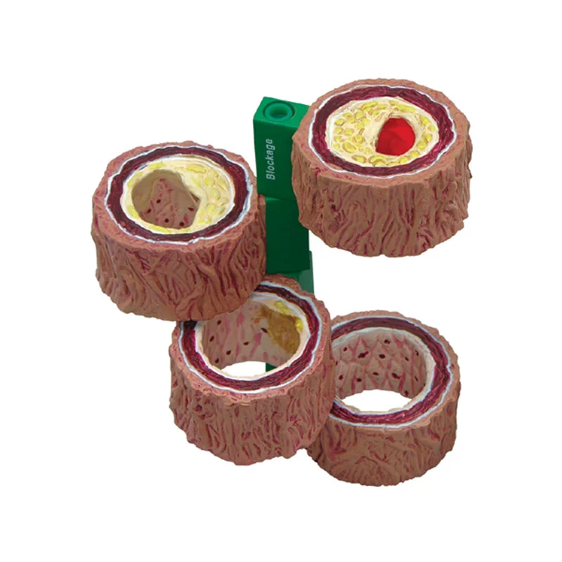 

Atherosclerosis Thrombosis model Vascular disease Demonstration Heart Vascular pathology model Teaching Supplies