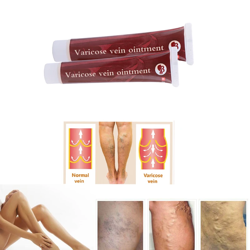 

10pcs Varicose Veins Treatment Cream Ointment Vasculitis Phlebitis Spider Veins Pain Varicosity Angiitis Remedy herbal medical