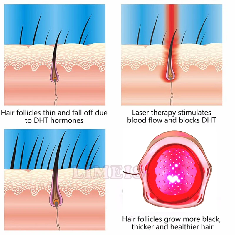 Горячее предложение! Распродажа! Лазерный шлем для восстановления волос 64/128 медицинский диодный лазер устройство для лечения восстановления волос против выпадения волос лазерный массаж для роста волос