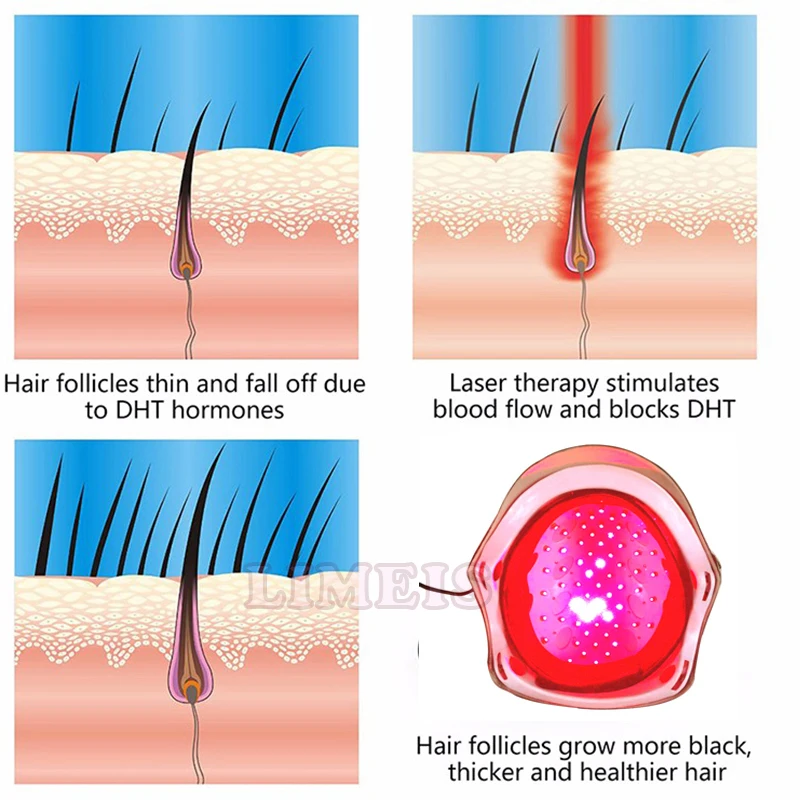 laser hair growth helemt 