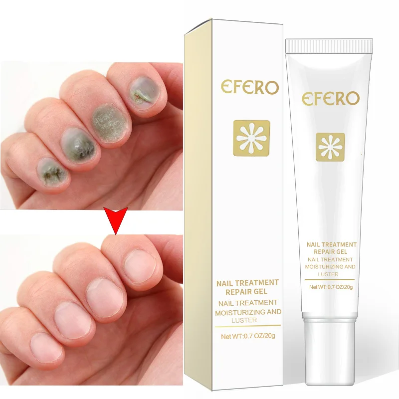 Efero Nail Fungus Treatment Onychomycosis Paronychia Anti Fungal Nail Infection Herb Good Result Toe Nail Treatment TSLM2