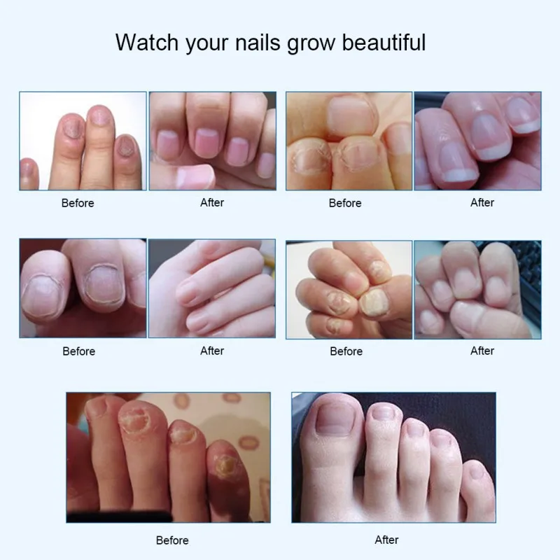 Fungal Nail Treatment Pen Effective Onychomycosis Paronychia Fungus Infection Repair Solution Gel Fingernails Toenails Care 3ml