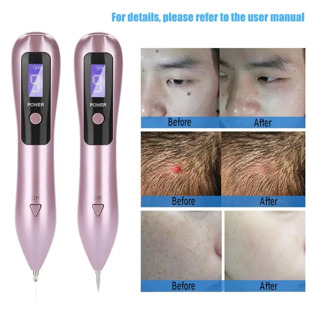 home laser removal pen