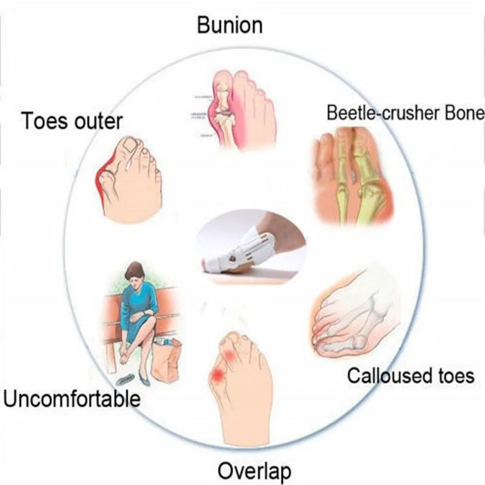 1 пара, большой костный носок, вальгусная деформация, шиповник, корректор ортопедический Pro для педикюра, ортопедические брекеты, инструмент для ухода за ногами