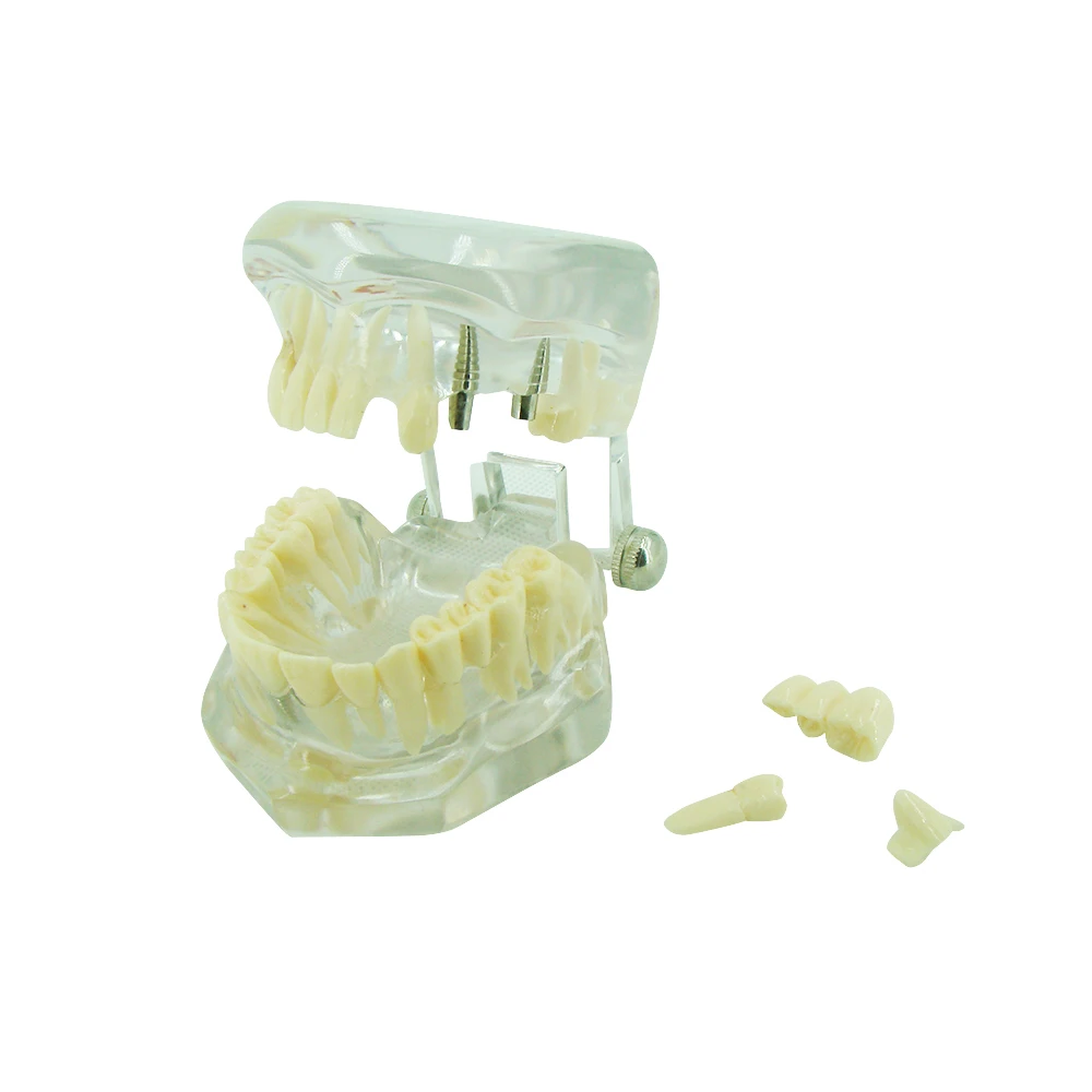 

A0171 Dental Teeth Model Implant Model Transparent Removable Teeth Model Teaching Teeth Tool Dental Adult Typodont For Medical