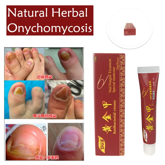 Nail Fungus Treatment / Onychomycosis Paronychia / Anti Fungal Nail
