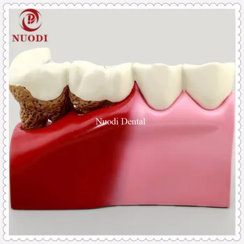 

Dentistry Disassembling Caries dental tooth Modelexplaining secondary caries after fitting prosthetic restoration