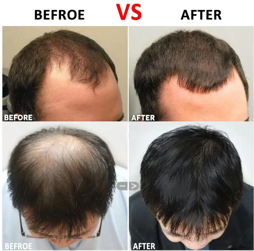 

Hair Regrowth Micro-needling Roller Beard Growth Product Anti Hair Loss