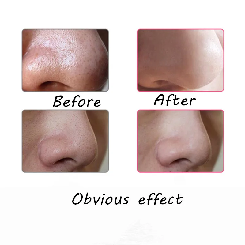 1 conjunto Acne Comedão Blackhead remover Pore