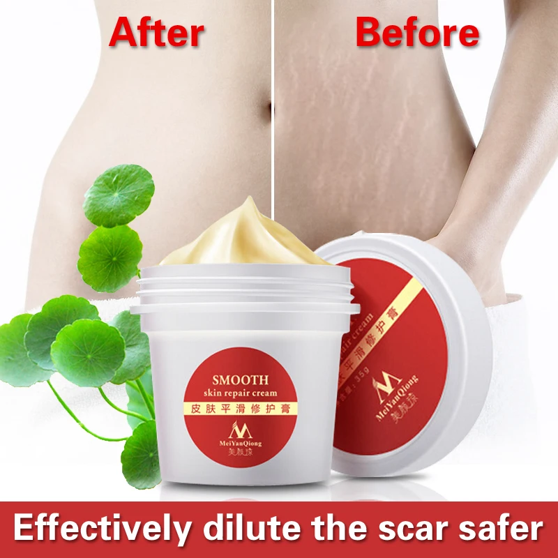 

High Quality Smooth Skin Cream For Stretch Marks Scar Removal To Maternity Skin Repair Cream Remove Scar Care Postpartum 2pcs