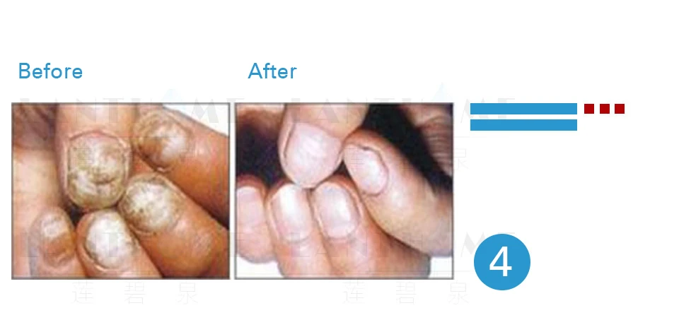 3 шт. грибковая обработка ногтей и ног отбеливающая эссенция удаление грибка для ногтей отбеливающая Onychomyco Уход за ногами и ногтями гелевые инструменты