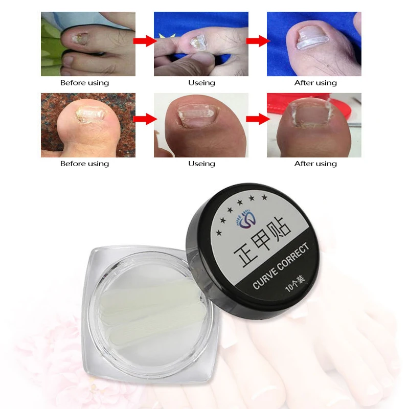

10pcs/box Ingrown Toe Nail Correction Sticker Patch Paronychia Correction File Elastic Patch Corrector Foot Care Treatment Tools