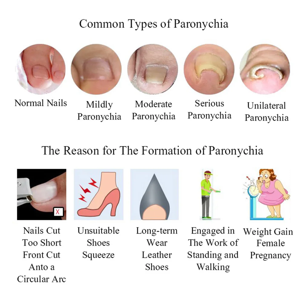 17 Pcs Toenail Ingrown Correction Tool Toe Nail Lifter Nail Glue Toenail Straightening Patch Pusher Recover Pedicure Foot Care