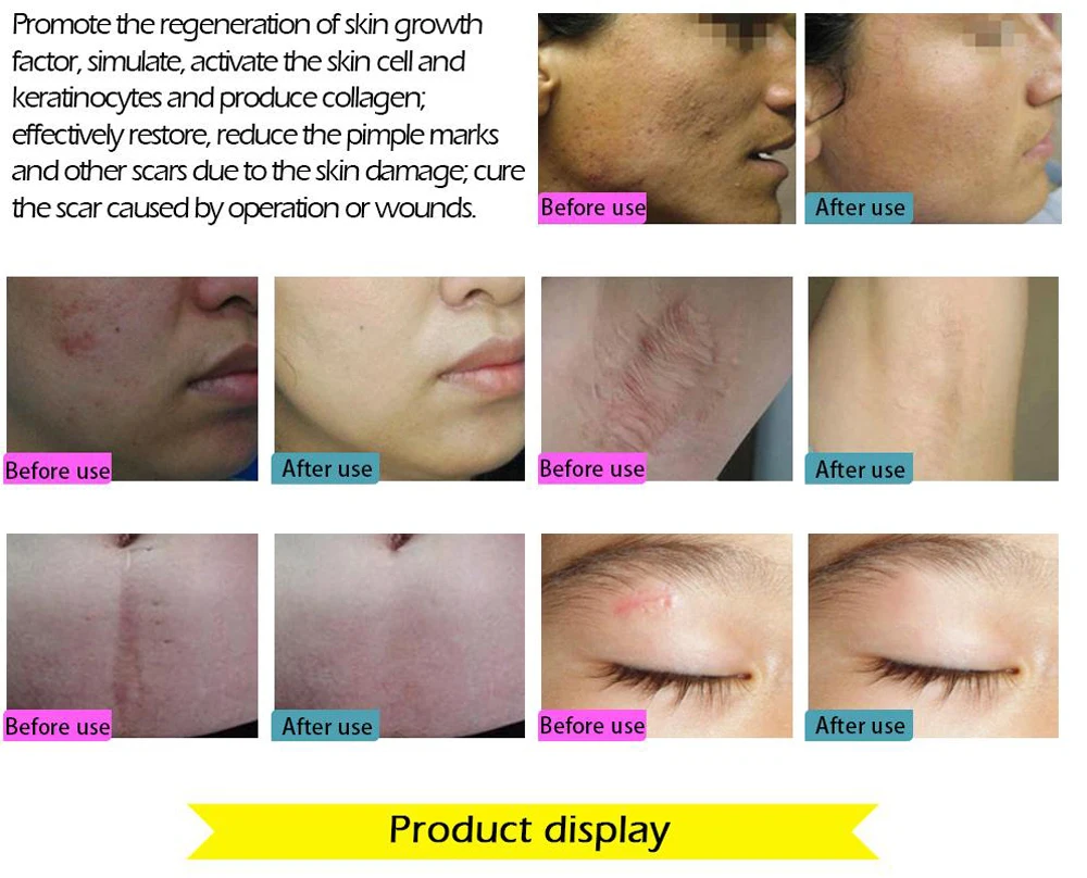 Face Care Essential Oil Acne Scar Spots Removal Skin Care Whitening Remove Scars Acne Repair Face 3