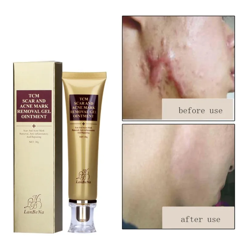 

30ml Chinese acne ointment extract against black dots cream scar removal facial acne skin care treatment