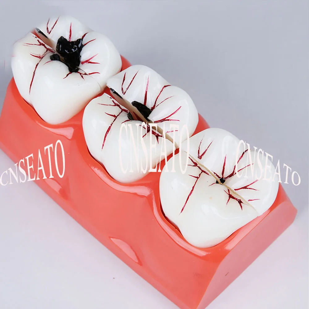 

1 Pcs Dental Caries Treatment Model Quadruple Demonstration Doctor Patient Communication Dental Model M4020