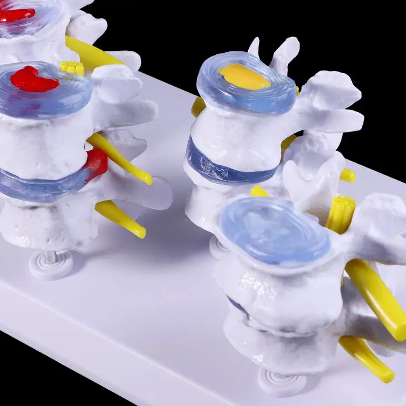 

1 Set Human Lumbar Lesion Spine Statue Display Model Medical Teaching Learning Tool