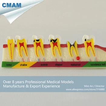 

DH/13151, Root Caries Anatomy, Caries Developing , Educational Teaching Anatomical Models