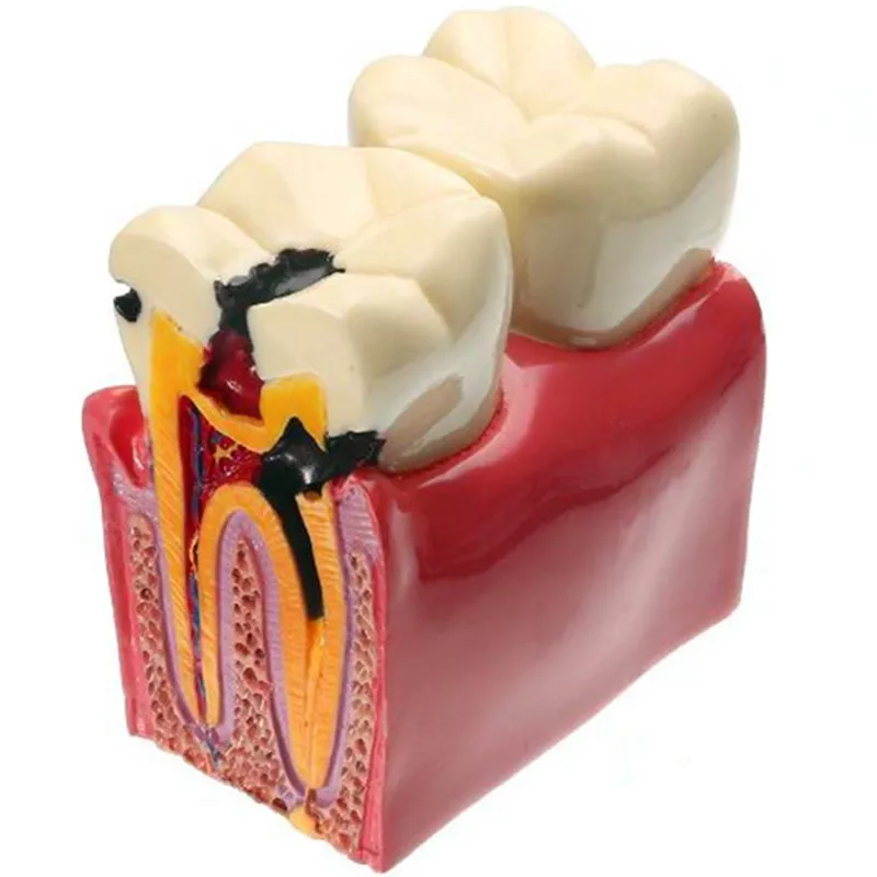 1 pc Dental Materials Lab Teeth Model 6 Times Caries Comparation Study Models For Dentist Studying a
