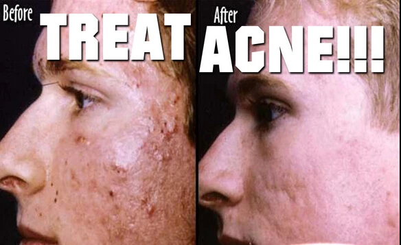 Retin A Scar Cream