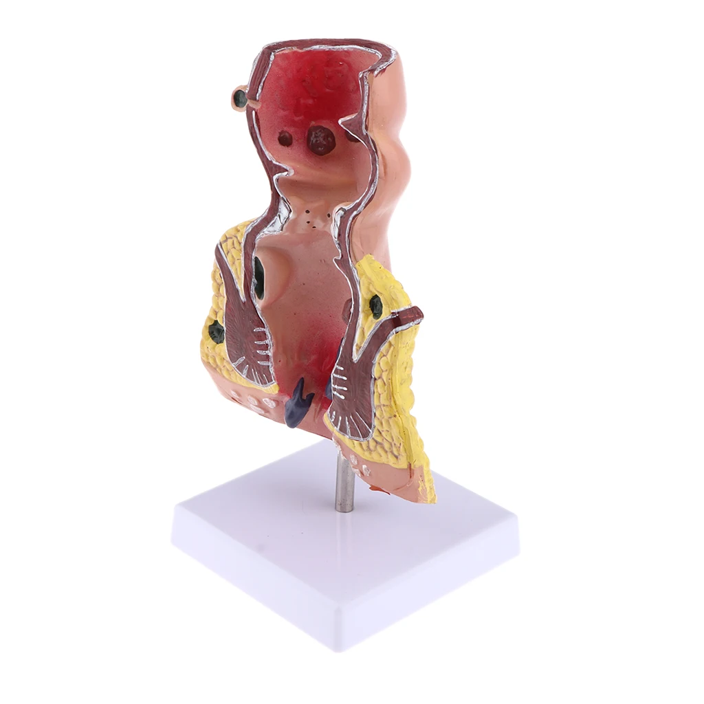 5x Pathological Rectum with Anus Hemorrhoid, Human Anatomical Model Anorectal Diseases Learning for Student Teacher Acss