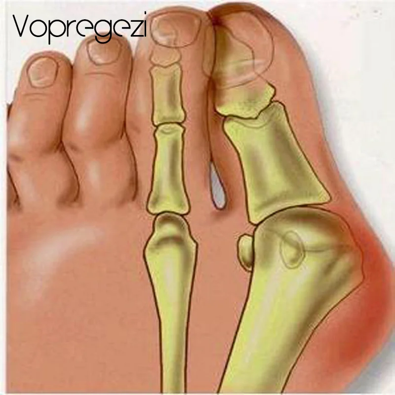 Vopregezi 1 шт. большая кость пальца ноги буйон шина Выпрямитель Корректор стопы облегчение боли вальгусной деформации коррекция педикюра Уход за ногами